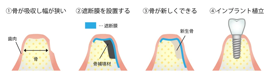 GBRの手順