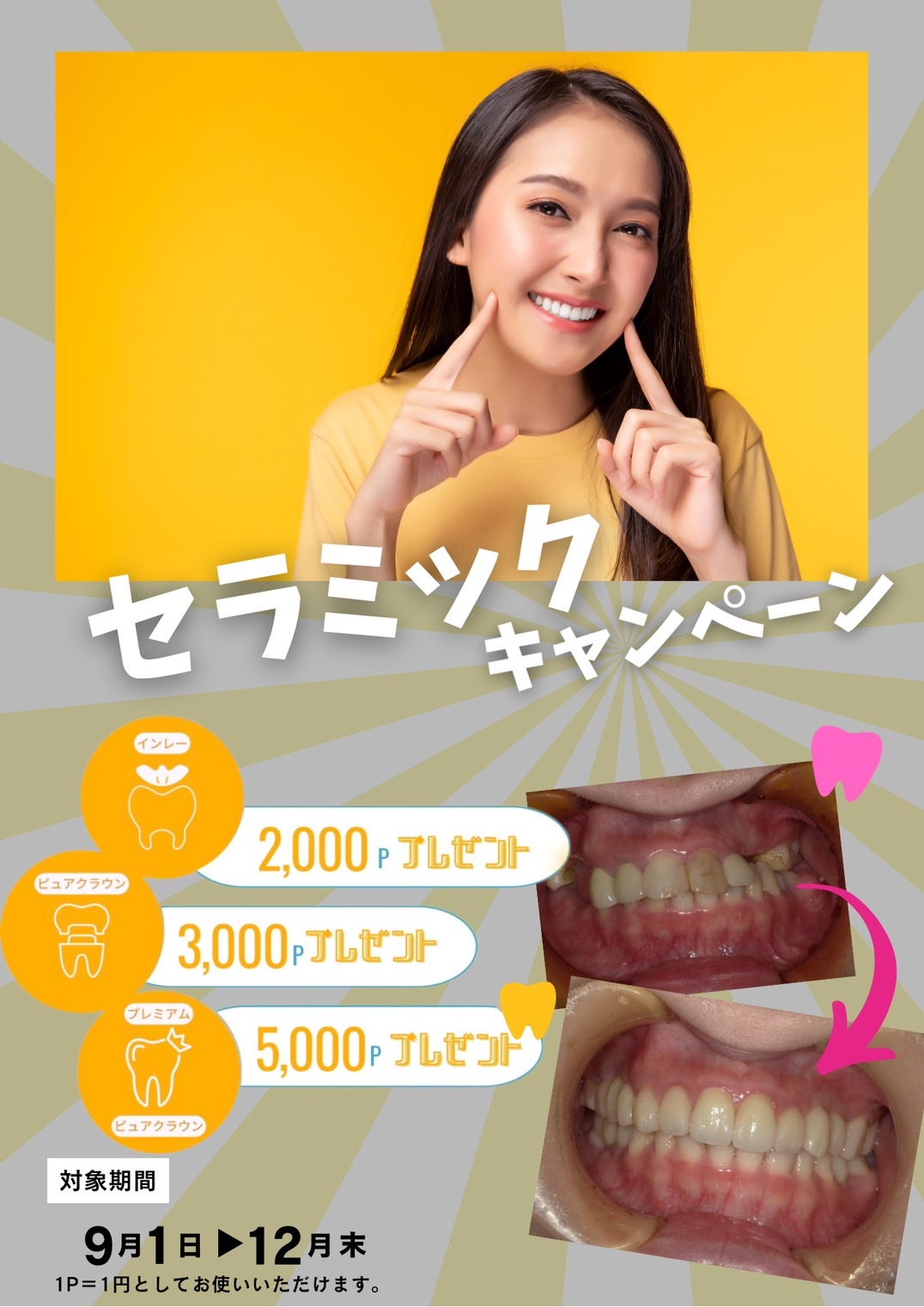 セラミックキャンペーン