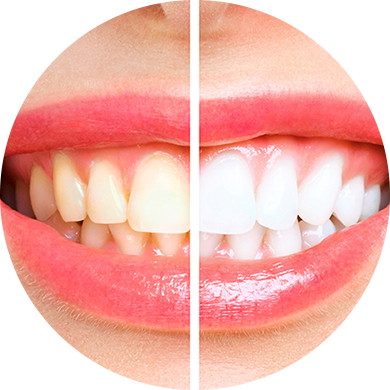 ホワイトニング