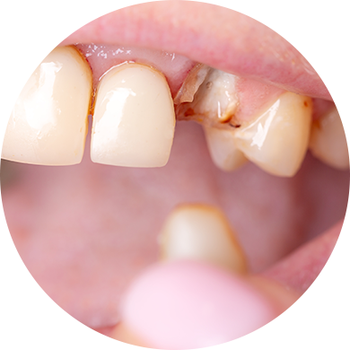 歯がボロボロの方へ