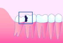親知らずの前の歯が虫歯や歯周病になる