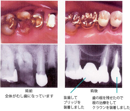 【C4】すでに神経を失った歯の虫歯