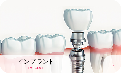 インプラント