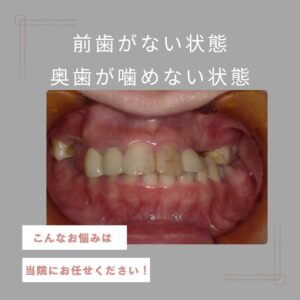 インプラント治療で全てのお悩みが解決！