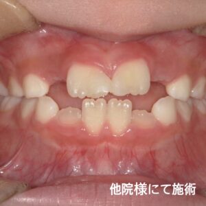 お子様の仮歯は当院にお任せください！