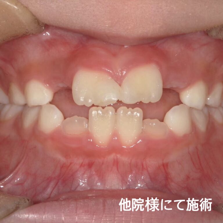 お子様の仮歯は当院にお任せください!