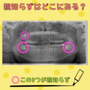 親知らずとは？抜かなくても良いの？