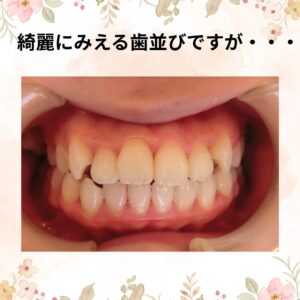 かみ合わせを改善すると美と健康が手に入ります～審美歯科なら恵比寿、伊勢原のピュアグループ～
