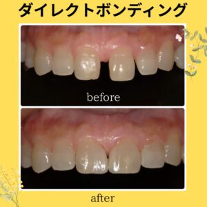 すきっ歯や出っ歯は治療できますか？〜 恵比寿、伊勢原のPUREグループ〜
