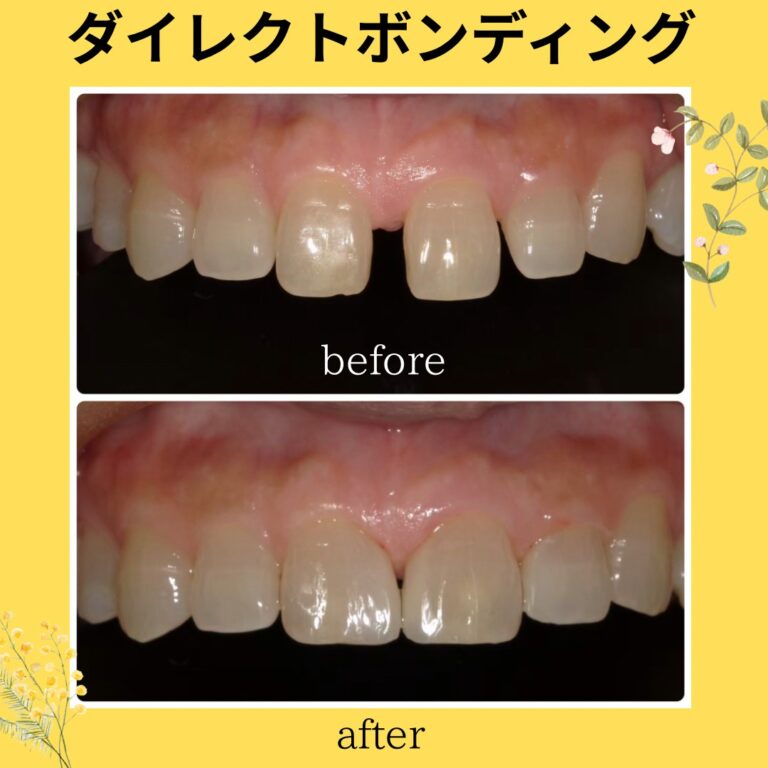 すきっ歯や出っ歯は治療できますか？〜 恵比寿、伊勢原のPUREグループ〜
