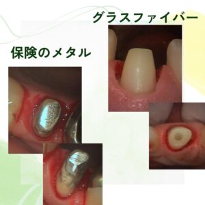 銀歯が気になる！上手に隠す方法はありますか？〜 恵比寿、伊勢原のピュアグループ〜