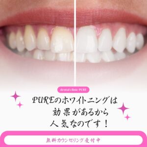 PUREのホワイトニングって実際どうなの?