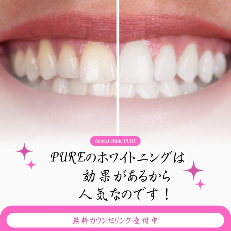 PUREのホワイトニングって実際どうなの？