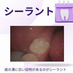 虫歯は歯の溝から始まりやすい