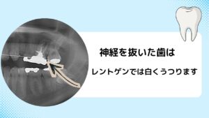 神経を抜くとどうなるの？