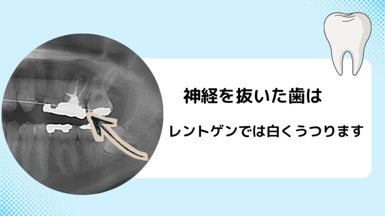 神経を抜くとどうなるの？