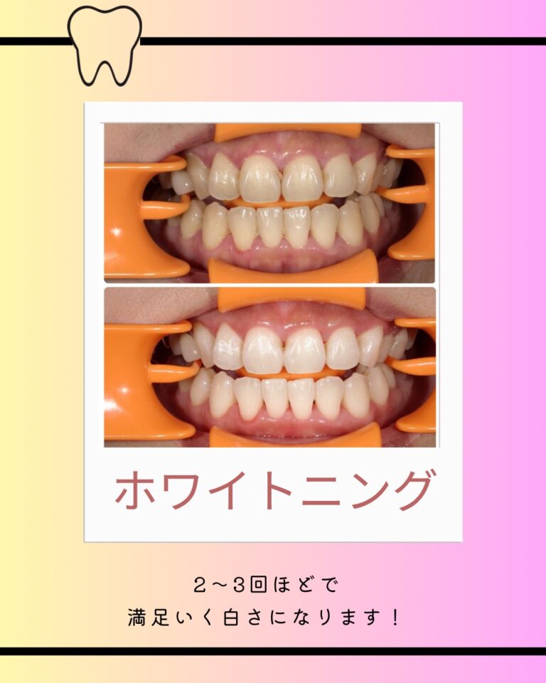 初めてのホワイトニング
