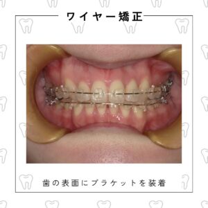 美しい歯並びと健康なお口を目指す治療はワイヤー矯正