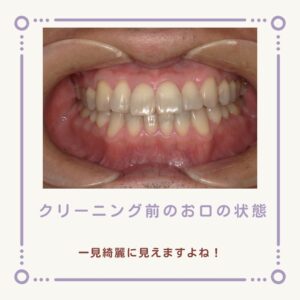 歯が痛くなる前が通院のタイミング!定期クリーニングのすすめ