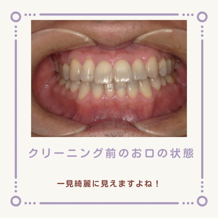 歯が痛くなる前が通院のタイミング！定期クリーニングのすすめ