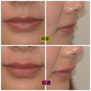 唇ヒアルロン酸とは？自然な美しさを歯科だからできる人気の美容施術