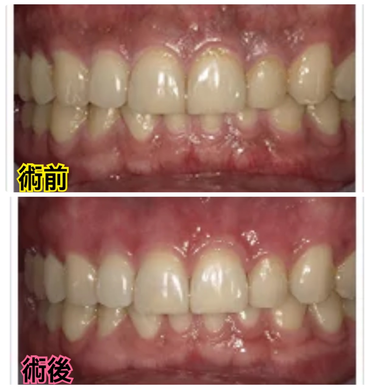 歯茎の黒ずみも実は改善できます